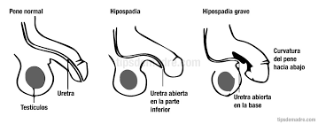Hipospadias (doğuştan sünnetli ollmak) nedir ve tedavisi nasıl yapılır? Hipospadias Que Es Y Mi Experiencia Tips De Madre