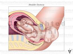 Image result for Shoulder Presentation