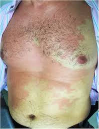 Image result for Scombroid Fish Poisoning