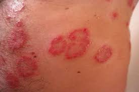 Medical Second Opinion Medisense Healthcare Solutions People and dogs pick up these spores through direct contact with an infected animal or person, or by indirect contact with a spore left in the environment. medical second opinion medisense