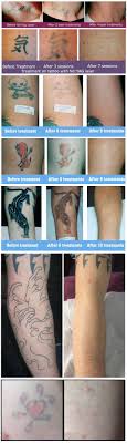 Keep in mind that most temporary tattoos are able to stand up to water and soap, so oil is generally the best way to go if you want to scrub a temporary tattoo off. Laser Tattoo Removal Outline Clinic Droitwich