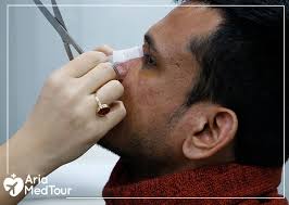 These include ariana grande nose job, beyonce and jennifer aniston nose job, kim kardashian nose job, kylie jenner nose job, sandra bullock nose job, bella hadid, jennifer lopez and stana katic nose job along with many more. Rhinoplasty Experience In Iran For Thick Skinned Nose Ariamedtour