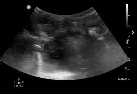 Image result for Peritonsillar Abscess