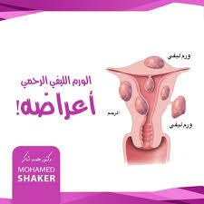 الورم الليفي الرحمي ايه اعراضه وازاي ممكن نعرف مكان نموه في الرحم عن طريق الاعراض الورم العضلي الموجود داخل تجويف الرحم تحت White Out Tape Shaker White Out