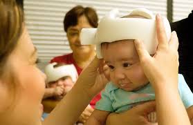 Baby Helmet Therapy On The Rise Houston Public Media