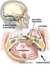 Pin On Acoustic Neuroma