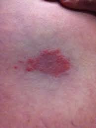 Maybe you would like to learn more about one of these? Lymska Borelioza Priznaky Lecba A Prevence