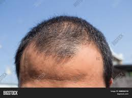 Medically, hair loss falls into several categories, including: Middle Aged Man Image Photo Free Trial Bigstock
