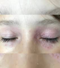 Skin allergies occur due to the sensitivity of our immune system towards external agents called allergens. 12 Home Remedies To Get Rid Of A Rash Around The Eyes