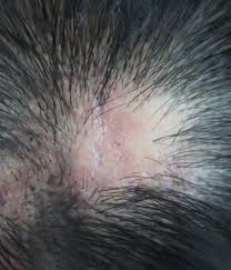 Shortly after my diagnosis i noticed some dark patches on my forehead and put it down to. Lichen Planus And Hair Loss Dr Batra S