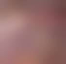 Image result for Rectal prolapse