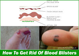 Pin On Home Remedies