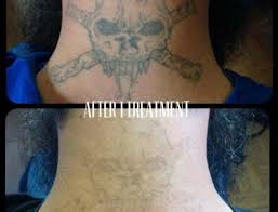 8 reviews of oregon aesthetics i've been coming to oregon aesthetics for a while now and let me tell you, this is where to get your tattoo removed for sure . Laser Tattoo Removal In Portland Or Cascade Tattoo Removal