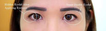 The only extra potential issues with a subciliary approach is the possible scar and risk of ectropion, which is the both surgical procedures would correct the bags. Dst Me Aesthetic Clinic Time Square Kl Review Spicy Sharon A Malaysian Lifestyle And Food Blog