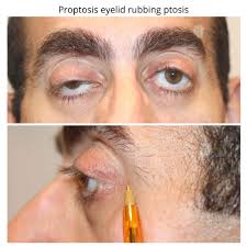 Image result for Proptosis