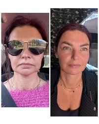 ✨ Lemon bottle & 5 point face lift combo ✨ One weeks difference after lemon  bottle fat dissolver in the "jowl" areas of the face/cheeks 💉 Such a huge  difference 🖤 Jodie ,