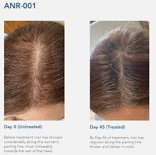 And helping understand the reasons for androgenetic alopecia. Follicle Thought Hair Growth Treatment News Hair Loss Cure News Treatments For Baldness