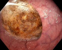 Image result for esophagus