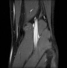 Quadriceps femoris of four muscle bellies. Accessory Muscles Of The Knee Radsource