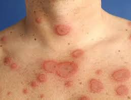 Image result for Erythema Multiforme Major