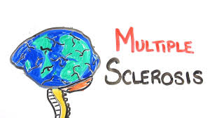 Primary progressive multiple sclerosis (ppms). What Is Multiple Sclerosis Youtube