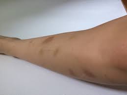 Hallo Ich Habe Seit Einiger Zeit Ziemlich Viele Blaue Flecken Aber Weiss Nicht Woher Ich Gehe Morgen Zum Arzt Habt Ihr Eine Vermutung Woher Das Kommen Kann Gesundheit Und Medizin Gesundheit Medizin