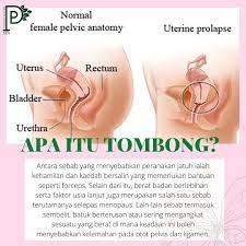 Turun peranakan atau prolaps uteri adalah kondisi ketika rahim turun hingga menonjol keluar vagina. Facebook