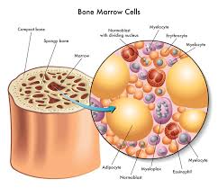 Cancerous cells overpopulate the bone marrow, reducing the production of other necessary cells and interfering with normal bodily functions. How Multiple Myeloma Of The Spine Is Diagnosed