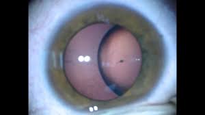 Subluxed Lens Ectopia Lentis Due To Marfan Syndrome Cionni Ctr Surgery Dr Simon Chen 1080p Hd Youtube