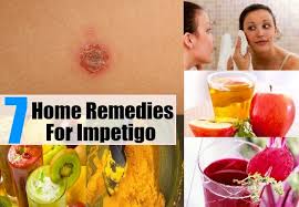 7 Home Remedies For Impetigo Impetigo Remedies Home Remedies