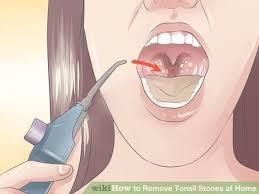 Black And White Spots On Tonsils Pin On Beauty Health Spa Nails Tips