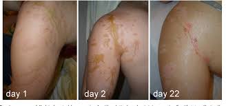 A chemical burn should be washed thoroughly with cold water. Figure 2 From The Nitric Acid Burn Trauma Of The Skin Semantic Scholar