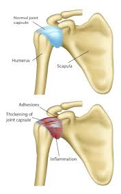 Image result for Frozen Shoulder