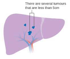 Eastern africa middle africa northern africa southern africa western africa. File Diagram 2 Of 2 Showing Stage 2 Liver Cancer Cruk 428 Svg Wikimedia Commons