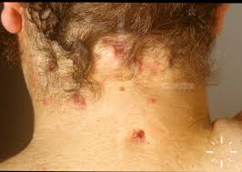 DermaCompass - Hidradenitis suppurativa