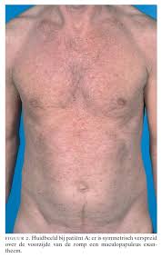 We did not find results for: Sterke Toename Van Het Aantal Syfilispatienten In Nederland Vroegtijdige Herkenning En Behandeling Van Groot Belang Nederlands Tijdschrift Voor Geneeskunde