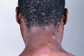 Their afferent vessels drain the occipital region of the scalp, while their efferents pass to the superior deep cervical glands. Kaposi S Sarcoma Photograph By Dr M A Ansary Science Photo Library