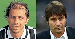 Inter will announce in the next hours the separation from antonio conte. All You Want To Know About Antonio Conte S Hair Transplant