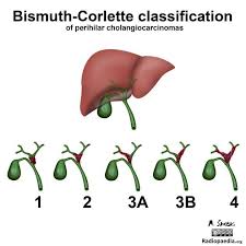The Bismuth Corlette Classification Defines The Anatomic Location Of The Tumor As Shown This Is Useful In D Radiology Bile Duct Cancer Human Digestive System
