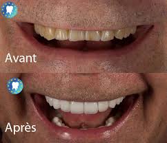 Elle accueille depuis l'année 2000, des patients francophones de suisse, france et de belgique. Resultats Photos Avant Apres En Hongrie Et Turquie