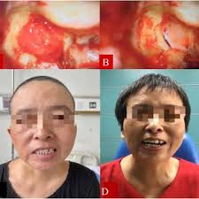 Intraoperative microscopic view of the Right main trunk and the...