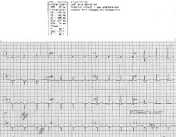 Image result for Right Axis Deviation