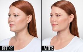 How A Dermatologist Can Eliminate Your Double Chin With An Injection Double Chin Double Chin Treatment Plastic Surgery
