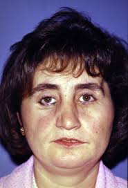 Comprehensive surgical management of cherubism with orbital involvement