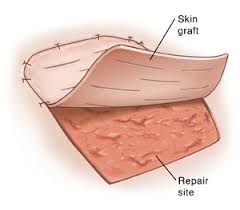 Skin Graft Surgery