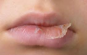 3 Common Lip Balm Ingredients That Irritate Your Lips Prevention