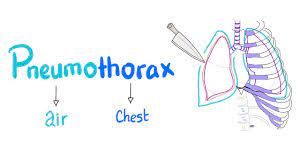 This includes the type of surgery recommended, the stage of your cancer, the location of your cancer, and your general health and lung function. Pneumothorax Physiopedia