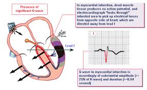 Image result for Q Wave