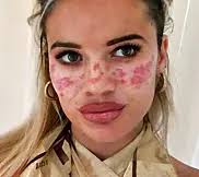 Megan McKenna viser fram brannskaden