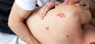 Various members of the health care team may collaborate to assist the patient in avoiding these problems. Bed Sores Are Frequent Menace For Immobile Bedridden Seniors Seniorsmatter Com